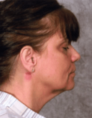 Before Mesolipotherapy