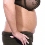 Before Mesolipotherapy 