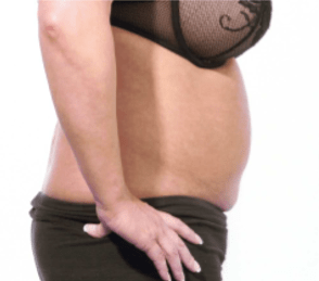 Before Mesolipotherapy