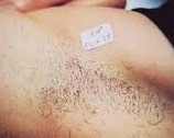 Before Laser Depigmentation