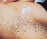 Before Laser Depigmentation 