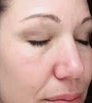 After Laser Photofacial 