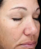Before Laser Photofacial