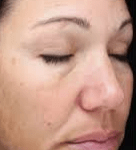 Before Laser Photofacial 