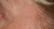 After Laser Depigmentation