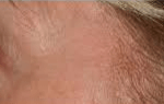 After Laser Depigmentation 