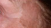 Before Laser Depigmentation