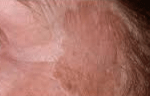 Before Laser Depigmentation 