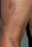 Before Laser Vein Treatment