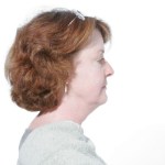 Before Mesolipotherapy 