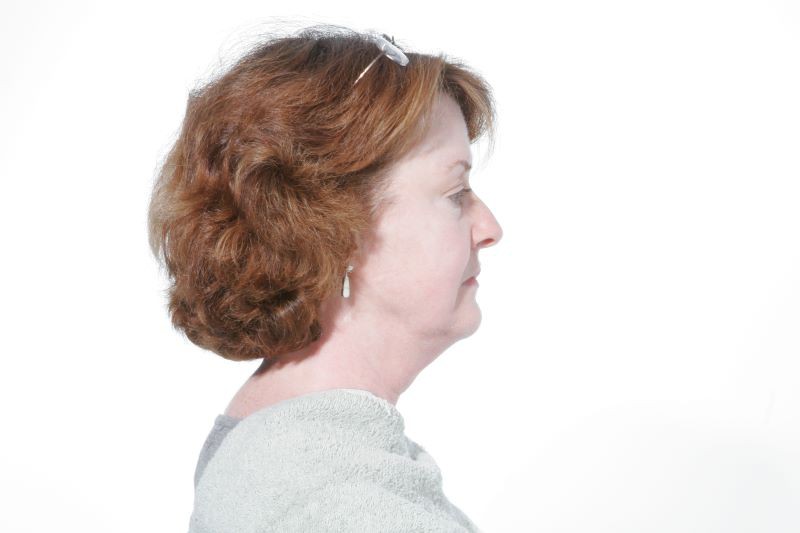 Before Mesolipotherapy