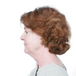 Before Mesolipotherapy 