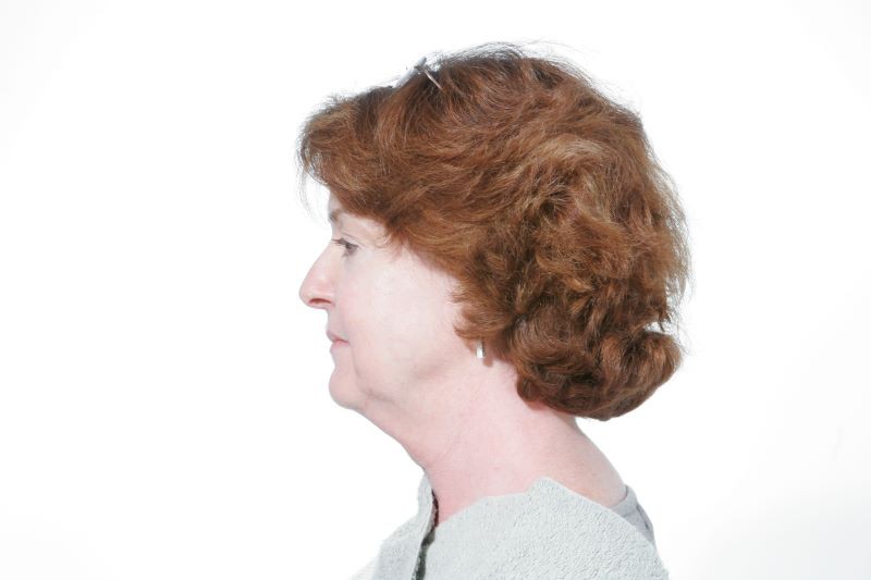 Before Mesolipotherapy