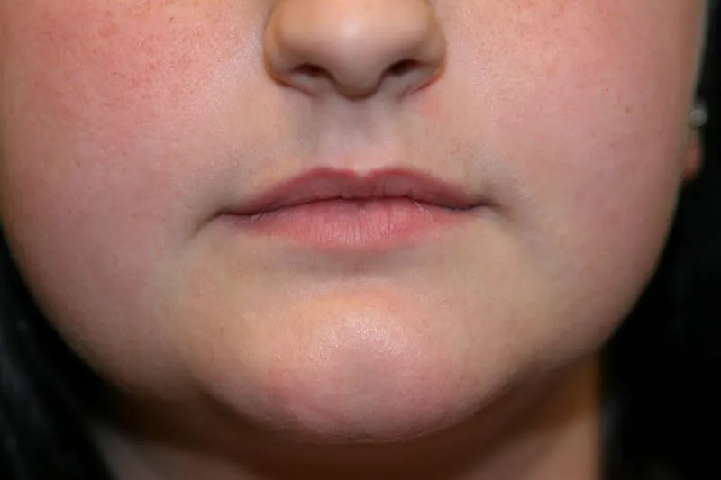 Before Lip Injection