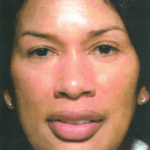 After Obagi Peel