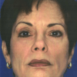 After Obagi Peel