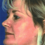 After Obagi Peel
