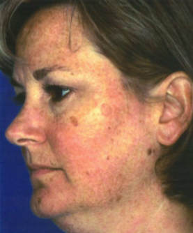 Before Obagi Peel