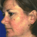 Before Obagi Peel