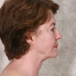 After Mesolipotherapy 