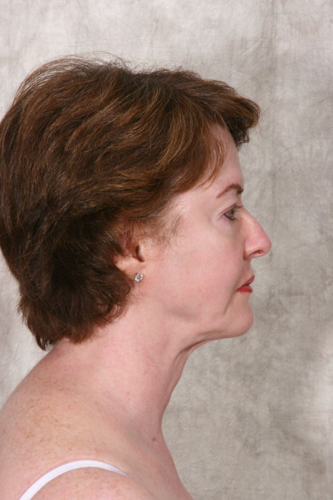 After Mesolipotherapy
