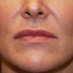After Lip Injection