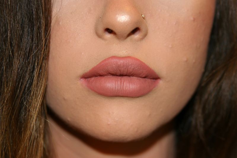 After Lip Injection