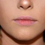 Before Lip Injection