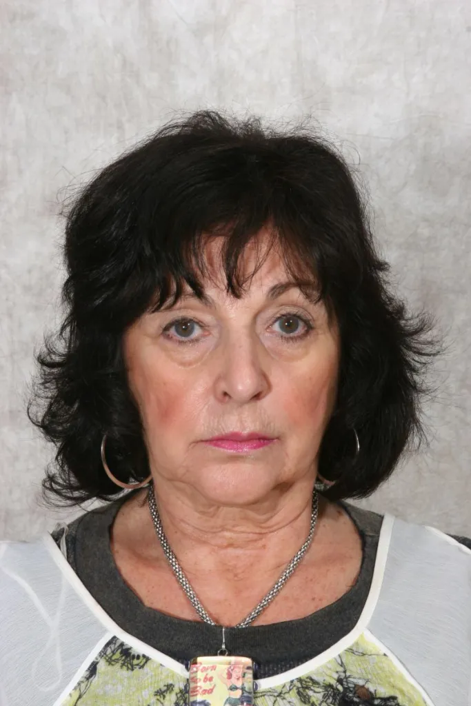 Before Sculptra