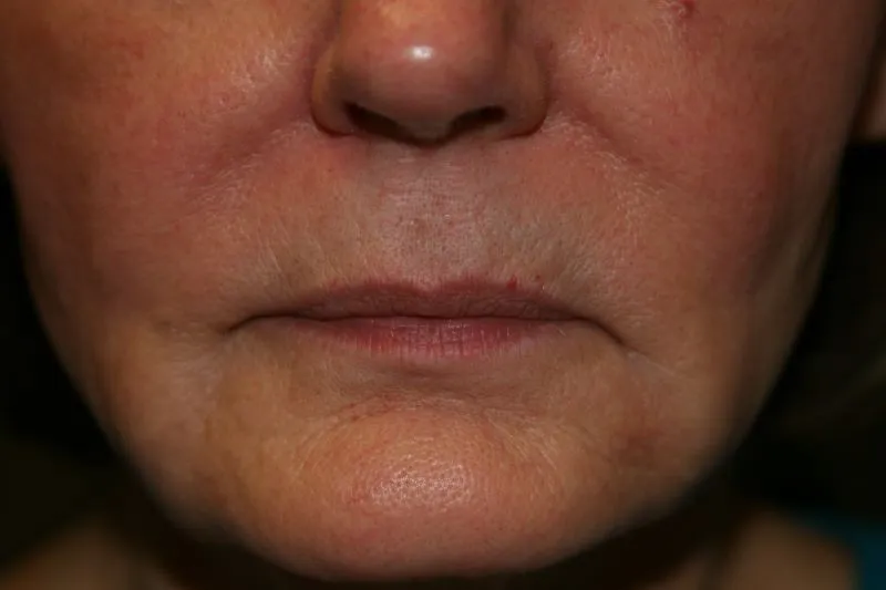 Before Lip Injection