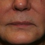Before Lip Injection