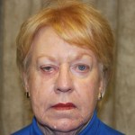 Before the correction of drooping eyelids