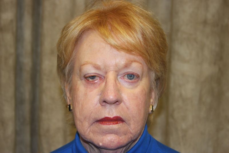 Before the correction of drooping eyelids