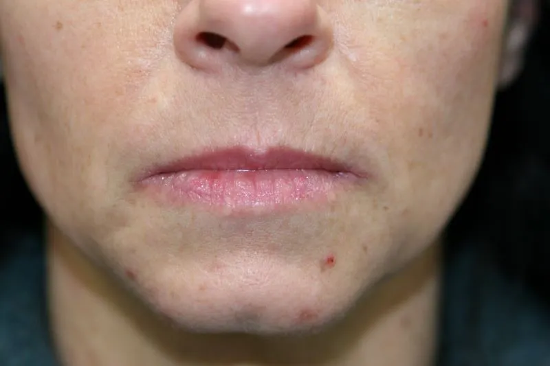 Before Lip Injection