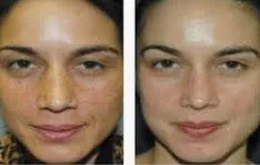 Before and after VI-Peel