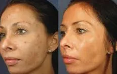 Before and after VI-Peel