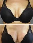 Before and after vampire breast lift