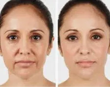 Before and after vampire facelift