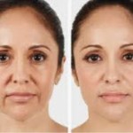 Before and after vampire facelift