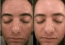 Before and after vampire facial