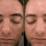 Before and after vampire facial 