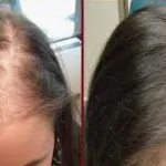 Before and after vampire hair growth