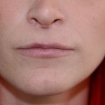 Before Lip Injection