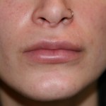 After Lip Injection