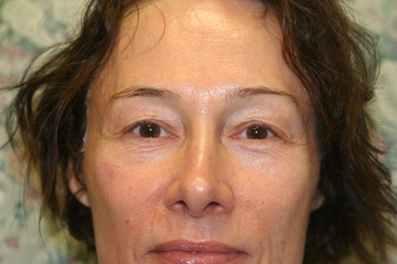 Before Upper Lid Lift
