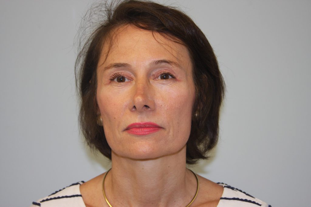 After Upper Lid Lift