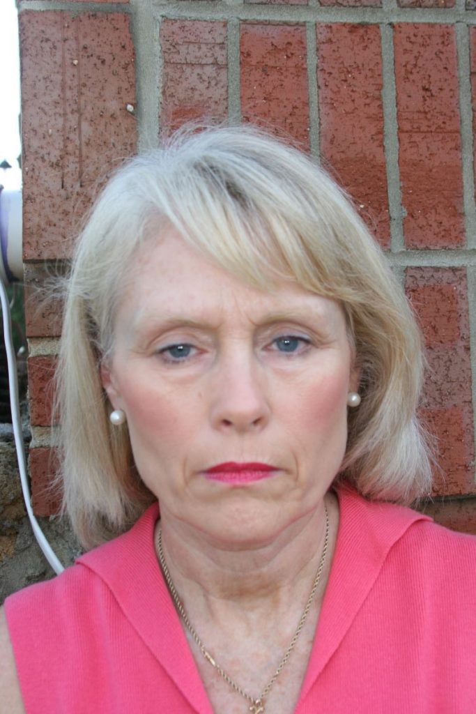 Before the correction of drooping eyelids