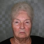 Before the correction of drooping eyelids
