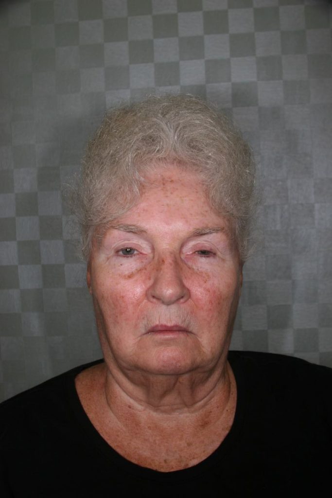 Before the correction of drooping eyelids