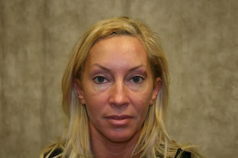 Before Sculptra